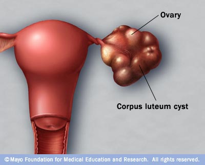 ch 9. Ovarian Cysts and Tumors | : Med Easy
