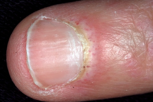 Dermatomyositis at Fingernail 